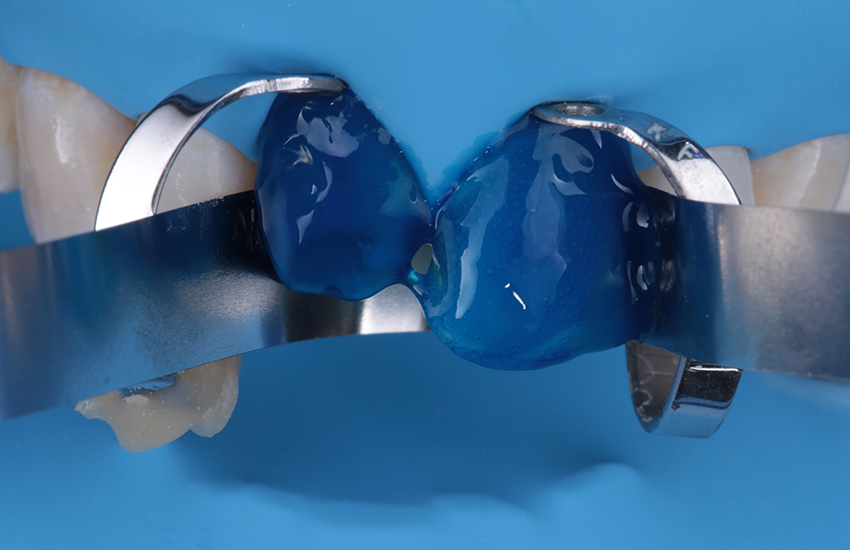 Ätzen der Präparationen mit Phosphorsäure. Bilder mit freundlicher Genehmigung von Dr. Paulo Monteiro.